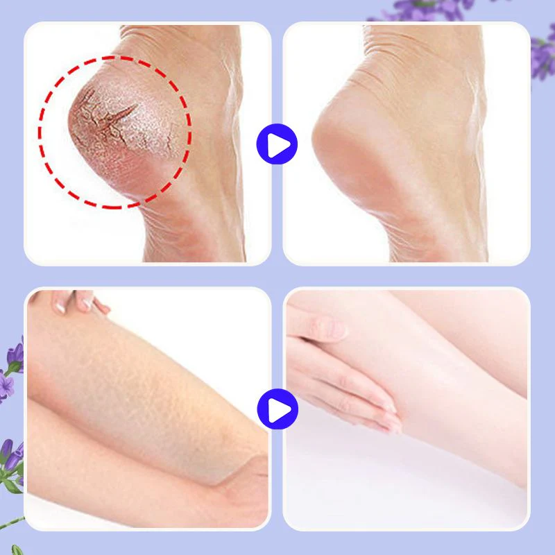 Nourishing and repairing dry and cracked skin  Look 20 years younger in an instant  Limited time 77% off  Come and give your feet a fresh new look!